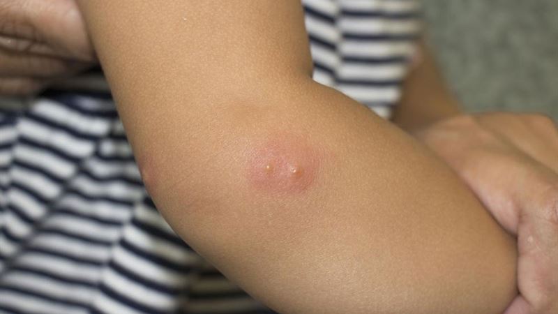 Comprehensive Guide to Shingles: Symptoms, Causes, and Treatments