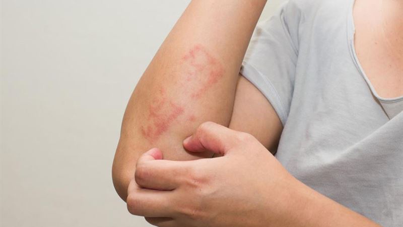 Comprehensive Guide to Recognizing and Treating Poison Ivy Rash Using Everyday Products