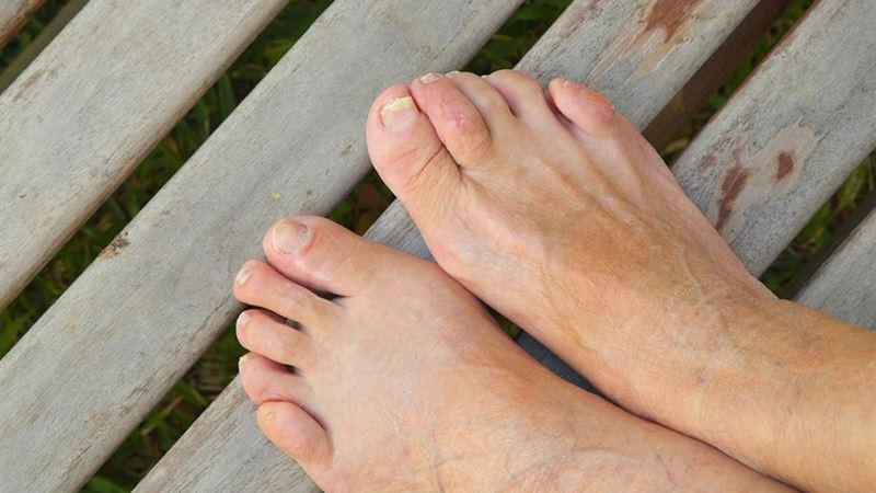 Effective Natural Treatments for Toenail Fungus: A Comprehensive Guide
