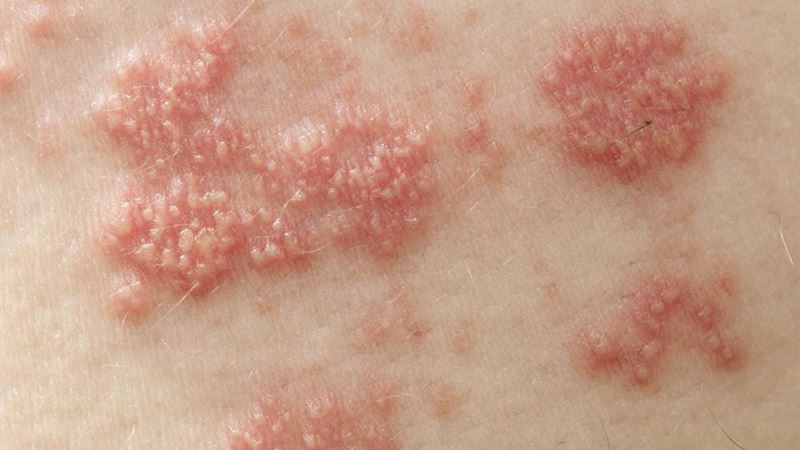 Comprehensive Guide to Shingles: Treatment Strategies and Natural Remedies