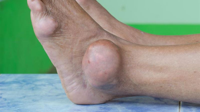 Comprehensive Strategies for Preventing and Managing Gout Foot Pain