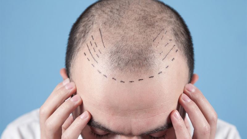 Comprehensive Guide to Hair Transplant Procedures: Techniques, Costs, and Tips for Choosing the Best Clinic