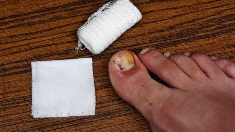 Effective Strategies for Combating Toenail Fungal Infections