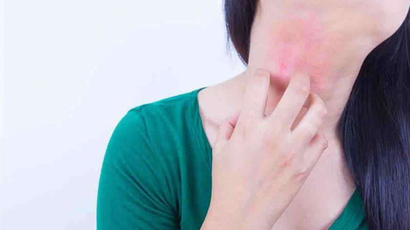 Top 10 Over-the-Counter Remedies for Eczema: Effective Solutions for Skin Relief