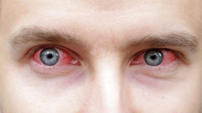 Effective Strategies for Managing Sjogren’s Syndrome Symptoms