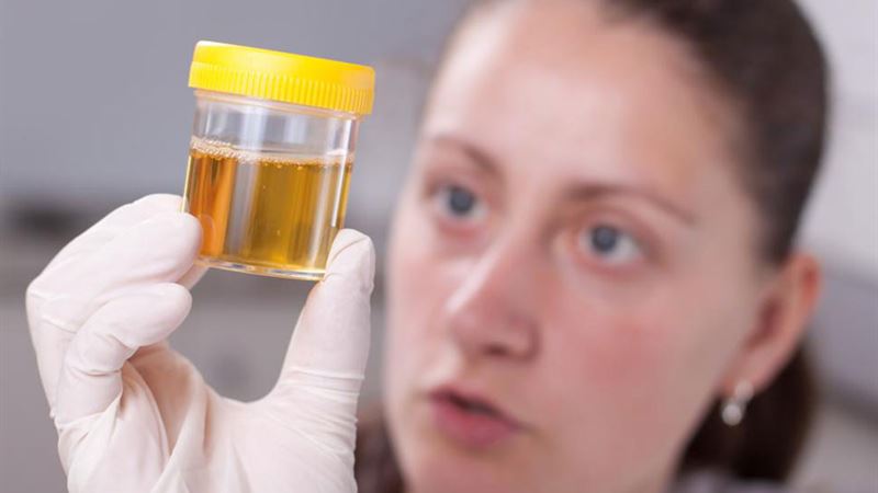 Understanding Urine Color Variations and Their Health Implications