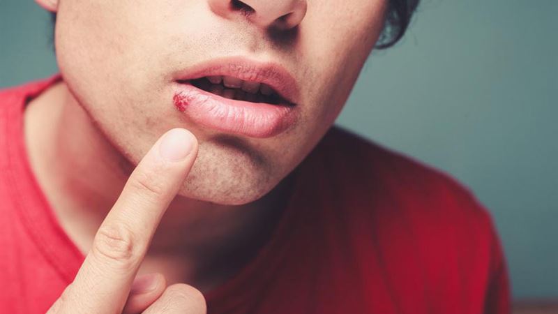 Comprehensive Guide to Managing Cold Sores: FAQs, Causes, Symptoms, and Rapid Treatments