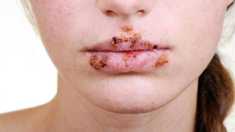 Comprehensive Strategies for Managing Herpes Outbreaks Effectively