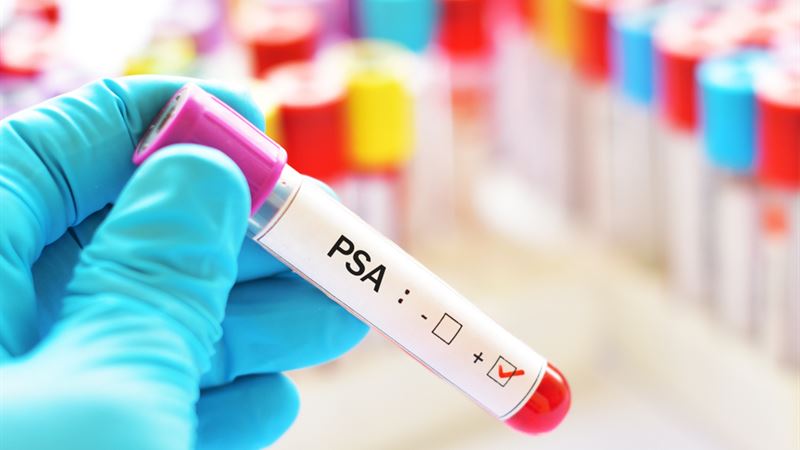 Understanding PSA Levels: Causes, Implications, and Strategies to Reduce Them