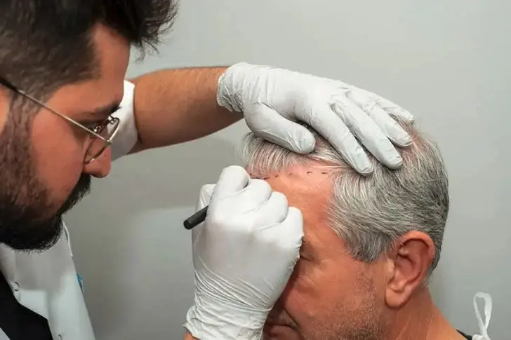Affordable Hair Transplant Solutions for Seniors in the United States: A Comprehensive Guide to Finding Budget-Friendly Options Nearby