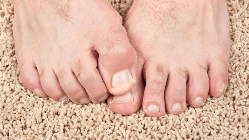 Comprehensive Home Solutions for Treating Toenail Fungus Naturally