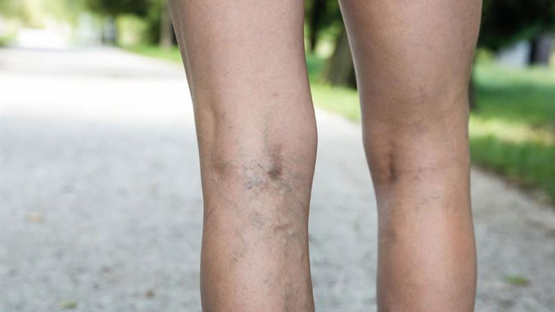 Comprehensive Guide to Understanding and Managing Deep Vein Thrombosis (DVT)