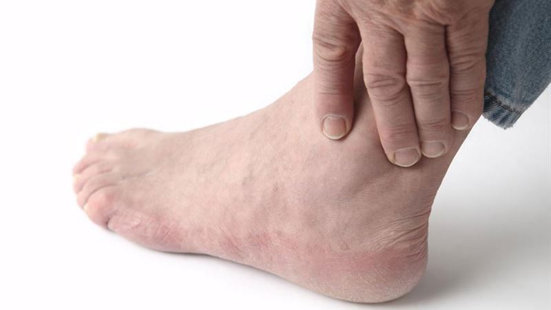 Effective Home Remedies for Alleviating Gout Foot Discomfort