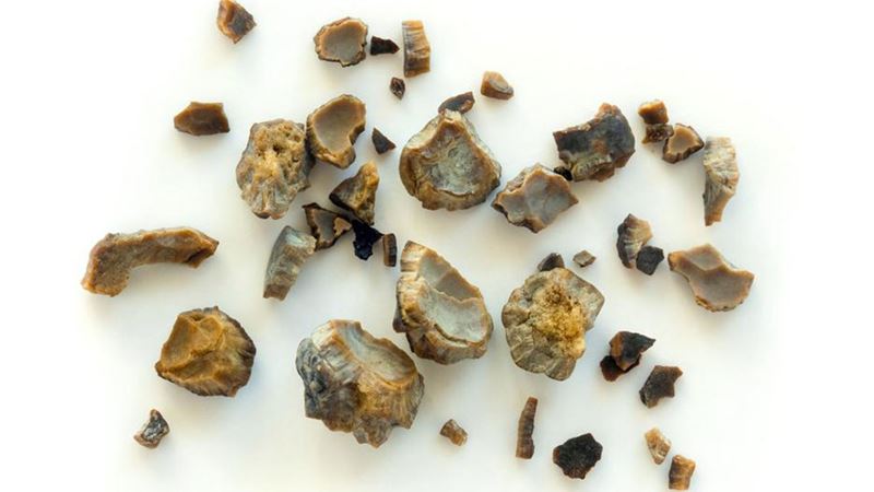 Understanding Uric Acid Kidney Stones: Causes, Risks, and Effective Treatments