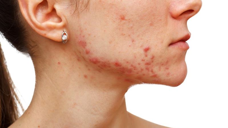 Comprehensive Guide to Recognizing and Managing Different Types of Eczema Symptoms