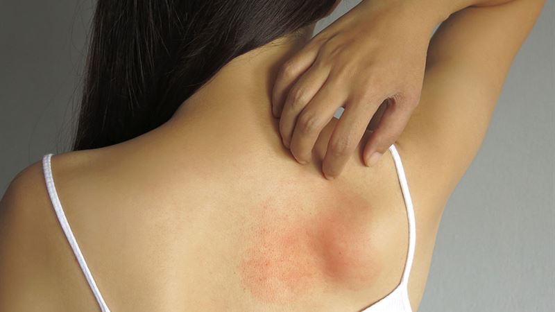 Comprehensive Guide to Allergies: Causes, Symptoms, Diagnosis, and Effective Treatments