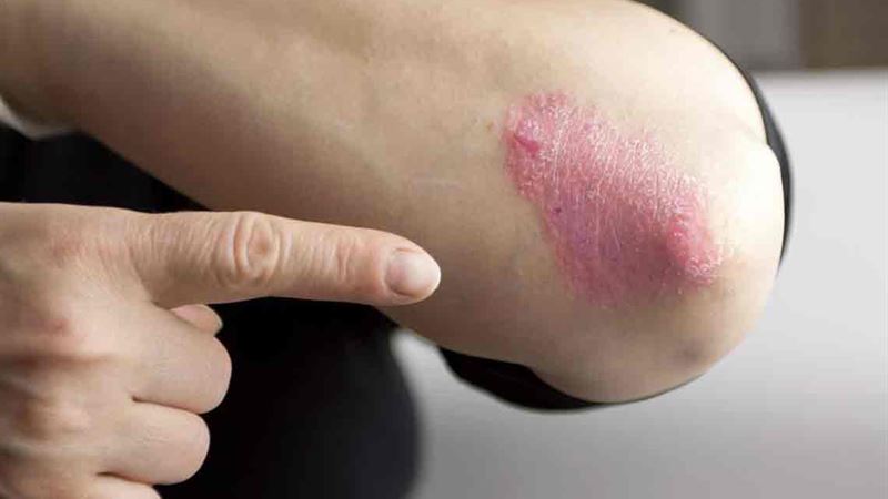 Comprehensive Approaches for Managing and Healing Psoriasis