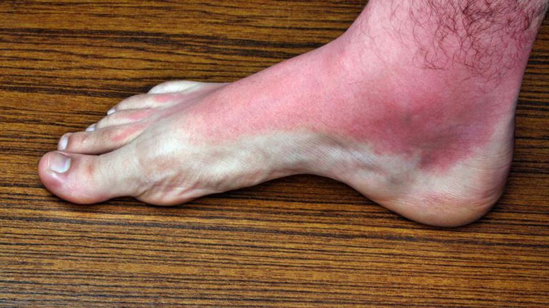 Comprehensive Guide to Heat Rash: Prevention, Symptoms, and Effective Treatments