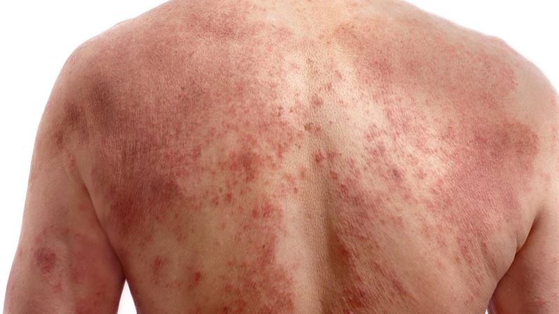 Comprehensive Guide to Effective Rosacea Treatment: Top Creams and Therapies