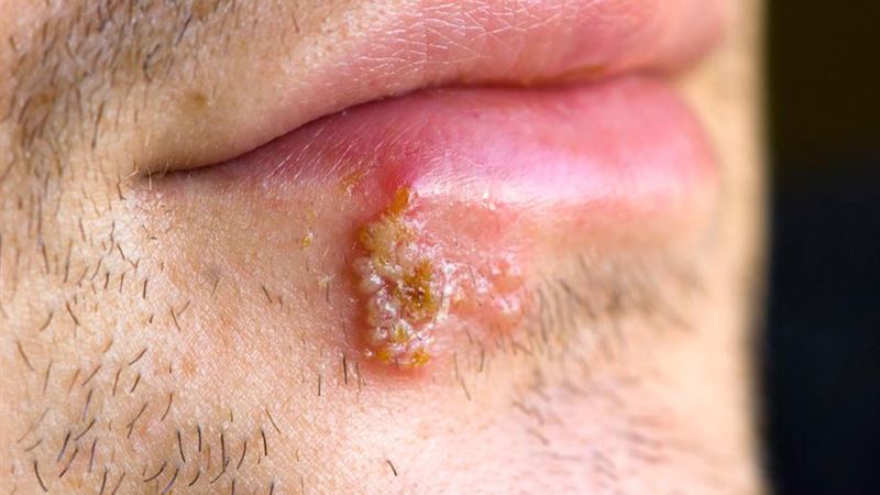 Recognizing the Key Indicators of Herpes Infection