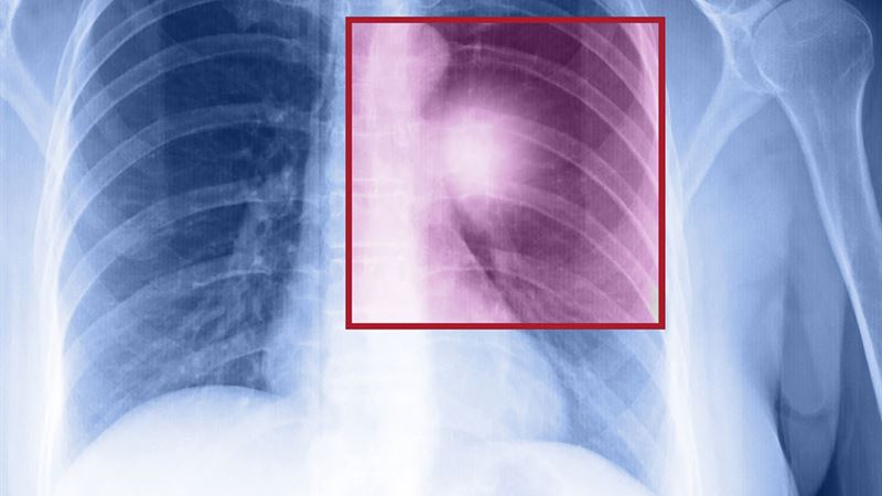 Comprehensive Guide to Recognizing and Managing Metastatic Lung Cancer