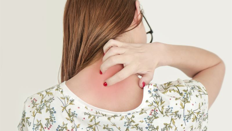 Comprehensive Guide to Shingles Prevention and Treatment Strategies