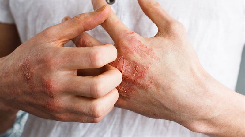 Comprehensive Guide to Managing Eczema Effectively