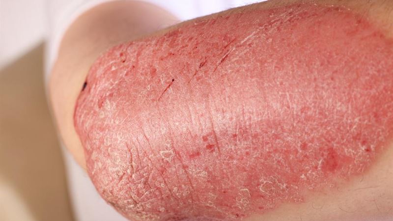 Comprehensive Guide to Eczema: Symptoms, Causes, Types, and Effective Treatment Strategies