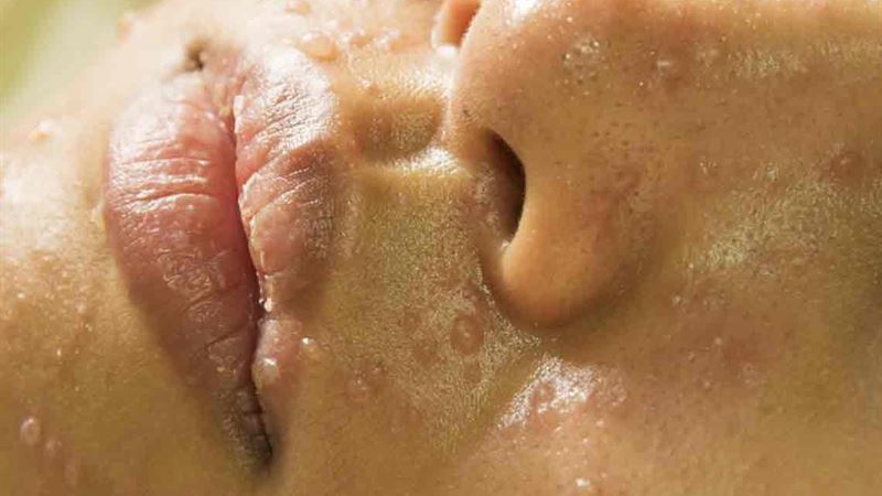 Effective Natural Remedies and Strategies for Managing Rosacea