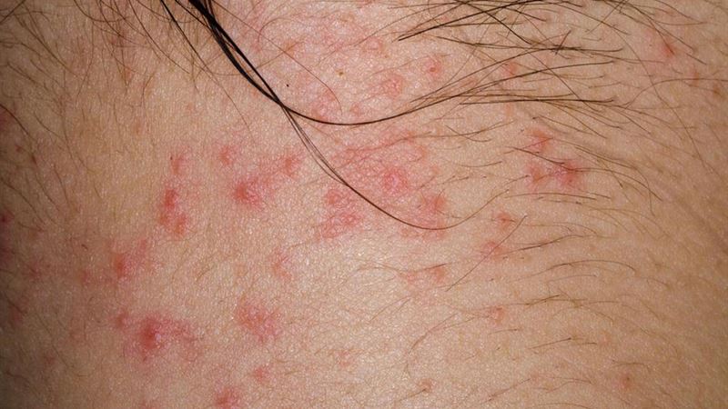 Understanding the Common Causes and Risk Factors of Atopic Dermatitis