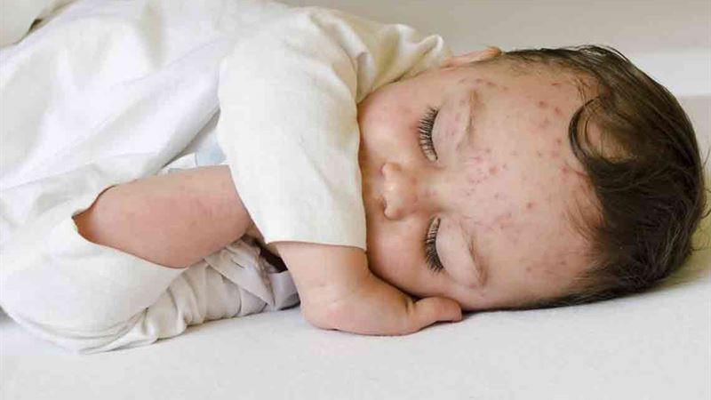 Comprehensive Guide to Topical Treatments for Shingles Relief