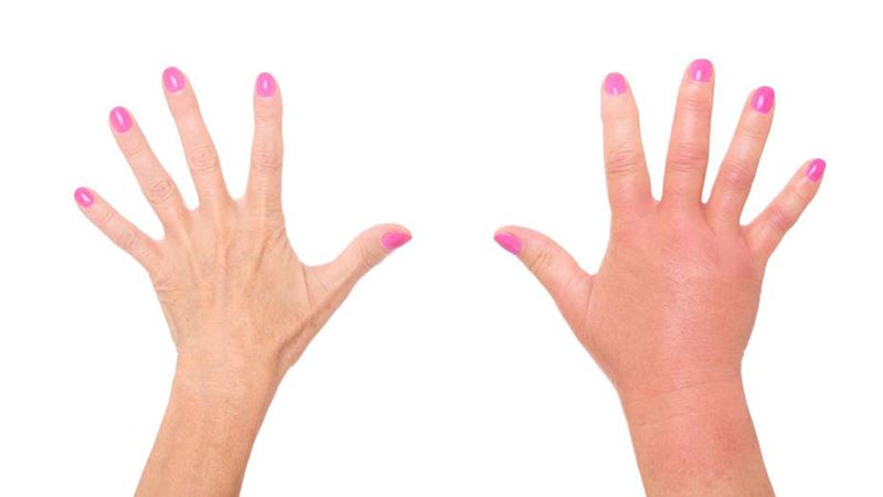 Debunking Common Myths About Hepatitis C: What You Need to Know