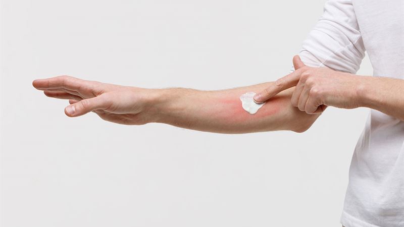 Comprehensive Guide to Atopic Dermatitis: Types, Symptoms, and Management Strategies