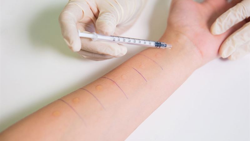 Comprehensive Guide to Identifying and Managing Allergies Effectively