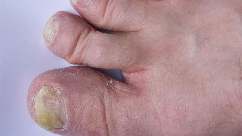 Comprehensive Strategies for Effective Toenail Fungus Treatment
