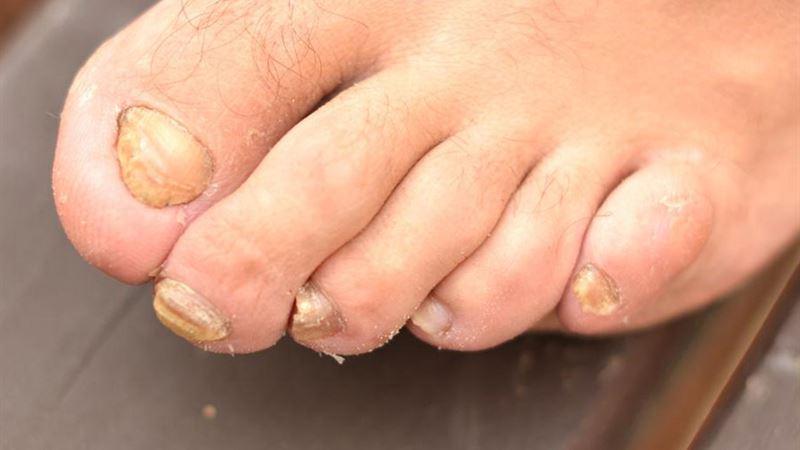 Comprehensive Guide to Toenail Fungus: Causes, Symptoms, Prevention, and Effective Treatments