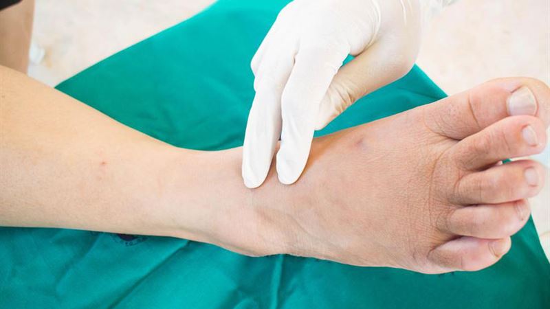 Effective Strategies for Early-Stage Gangrene Treatment and Management