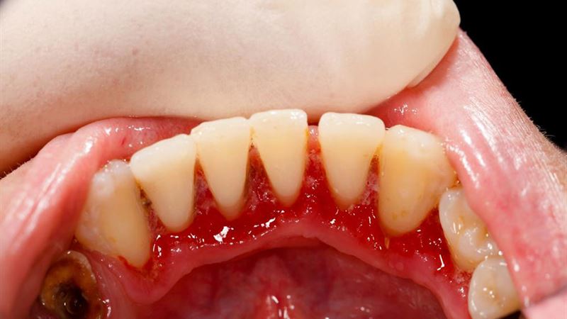 Comprehensive Guide to Over 8 Natural Remedies for Gum Health Restoration