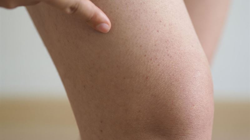 Comprehensive Guide to Hemophilia Treatment Options