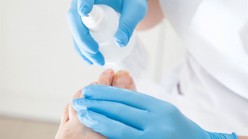 Comprehensive Guide to Toenail Fungus: Recognizing Symptoms and Effective Treatment Options