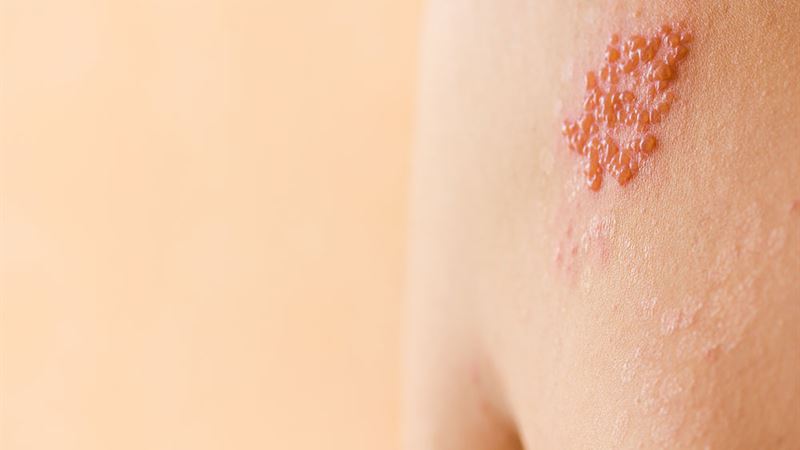 Understanding Shingles: Symptoms, Causes, and Prevention Strategies