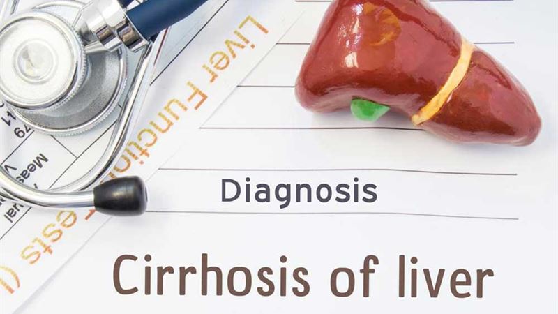Understanding Liver Cirrhosis: Progression and Management Across Its Four Stages