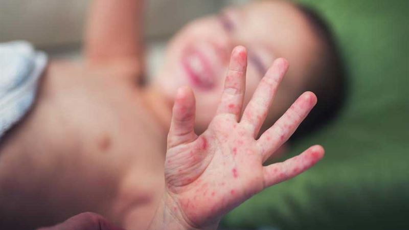 Essential Strategies to Prevent Hand, Foot, and Mouth Disease in Children and Adults