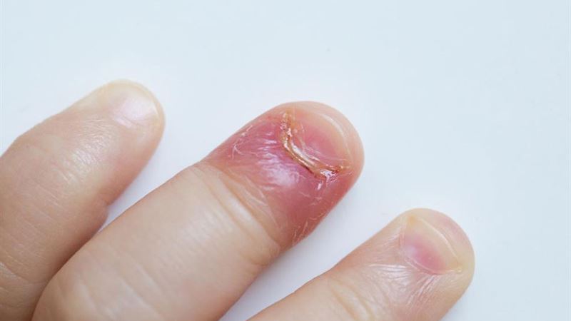 Top Causes and Remedies for Swollen Finger Pain