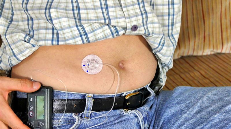 Comprehensive Guide to Advanced Insulin Delivery Systems for Diabetes Management