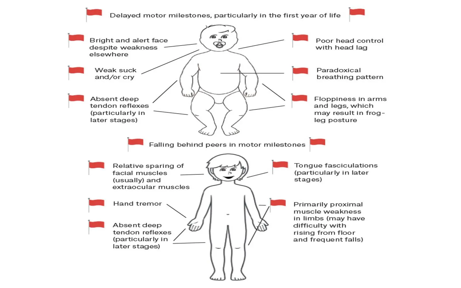 Comprehensive Overview of Spinal Muscular Atrophy (SMA): Symptoms, Early Detection, and Management Strategies