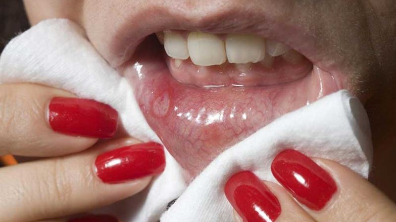 Understanding Oral Cancer: Causes, Early Warning Signs, and Prevention Strategies