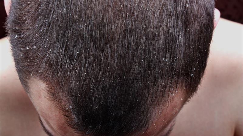 Comprehensive Guide to Managing Scalp Psoriasis: Causes, Symptoms, and Treatments