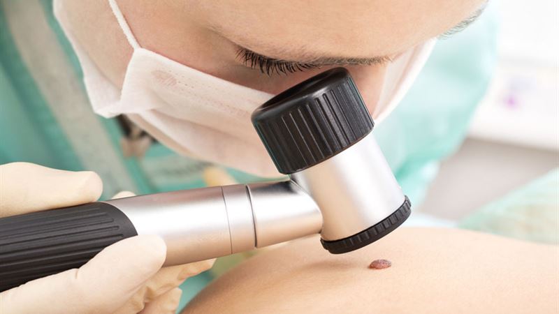 Comprehensive Guide to Systemic Treatments for Advanced Melanoma