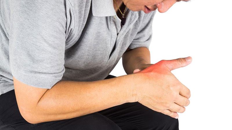 Comprehensive Guide to Managing and Treating Gout Naturally and Medically